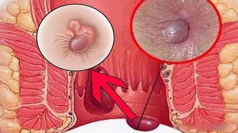 Trĩ lâu năm sa búi gây chảy máu
