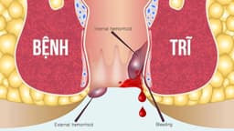 Trĩ ngoại viêm có triệu chứng gì? Điều trị và phòng ngừa như thế nào để đạt hiệu quả?