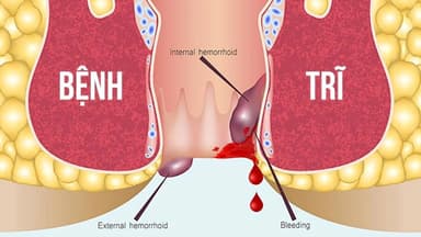 Trĩ ngoại viêm có triệu chứng gì? Điều trị và phòng ngừa như thế nào để đạt hiệu quả?