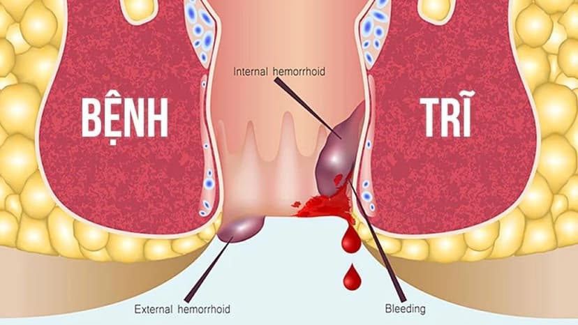 Trĩ ngoại viêm có triệu chứng gì? Điều trị và phòng ngừa như thế nào để đạt hiệu quả?