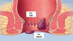 Trĩ nội chảy máu có nguy hiểm không và điều trị thế nào?