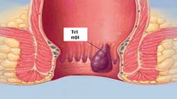 Trĩ nội sa búi là bệnh gì? Dấu hiệu nhận biết và cách chữa