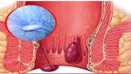 Trĩ tắc mạch là gì? Dấu hiệu nhận biết và cách điều trị hiệu quả