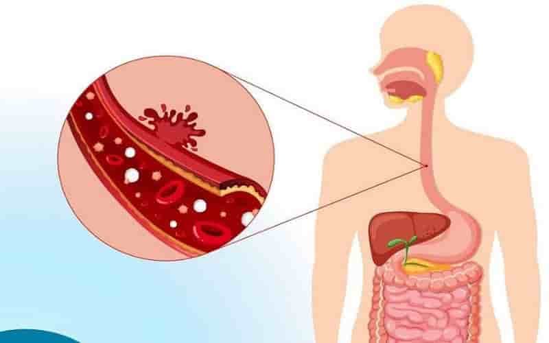 Giãn tĩnh mạch thực quản bị vỡ có thể gây nôn ra máu đột ngột