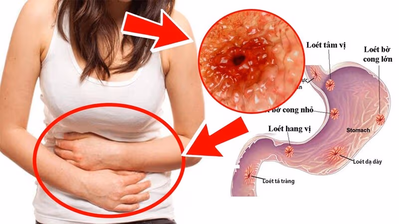 Các triệu chứng điển hình của hẹp môn vị