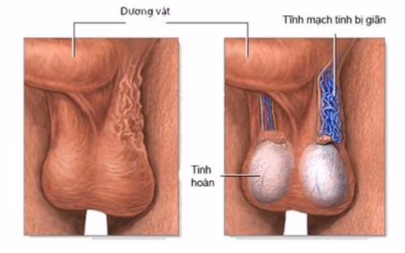 Triệu chứng khi giãn tĩnh mạch thừng tinh