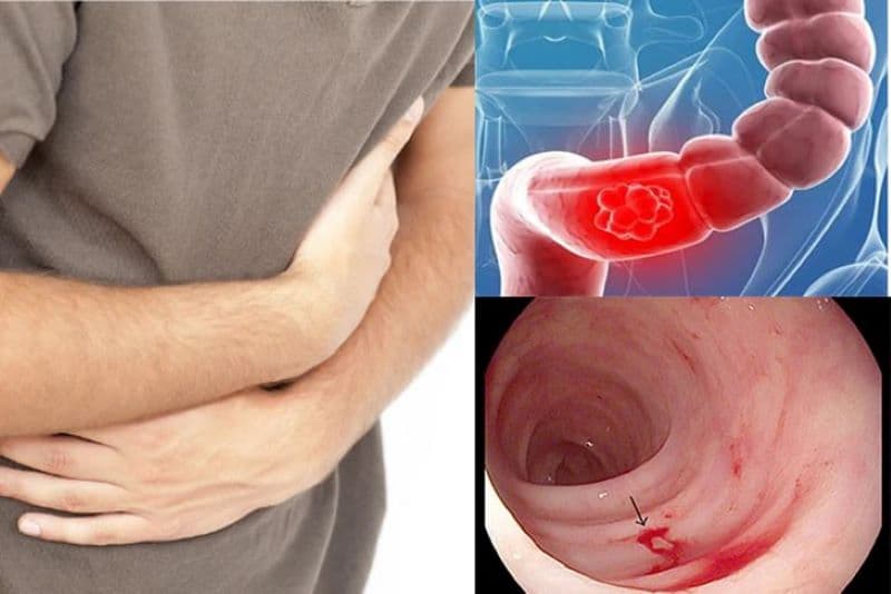 Triệu chứng nhận biết loét trực tràng đơn độc