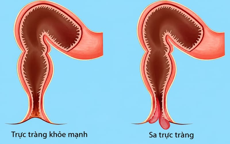 Trường hợp khối sa trực tràng bị nghẹt có thể gây hoại tử