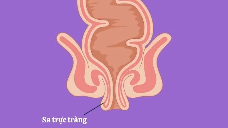 Phần cuối của trực tràng bị trượt khỏi vị trí giải phẫu bình thường