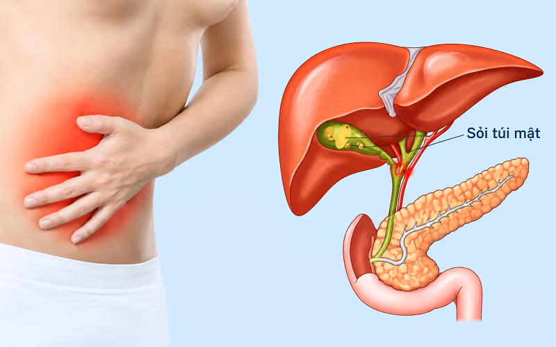 Sỏi túi mật thường gây đau bụng bên phải