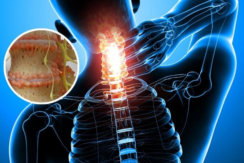 Theo thời gian, đĩa đệm mất nước, giảm độ đàn hồi và làm gia tăng nguy cơ hình thành gai xương