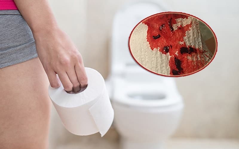 Đi ngoài ra máu là triệu chứng điển hình của ung thư đại tràng
