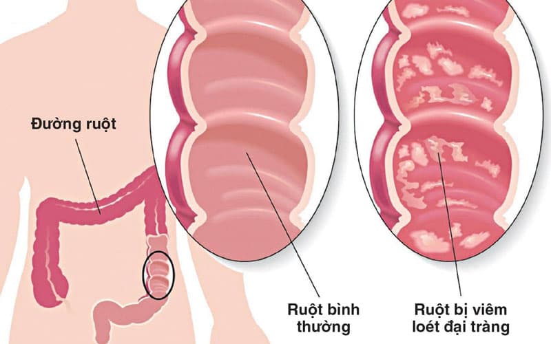 Tình trạng viêm trực tràng loét có thể lan rộng nếu không được điều trị