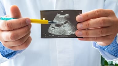 Túi mật sứ là gì? Nguyên nhân, dấu hiệu và mức độ nguy hiểm