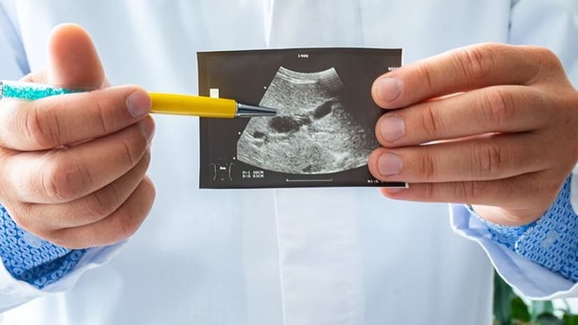 Túi mật sứ là gì? Nguyên nhân, dấu hiệu và mức độ nguy hiểm