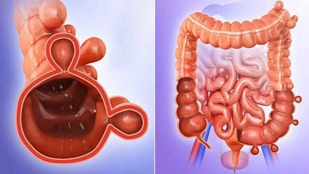 Chế độ ăn túi thừa đại tràng: Nên ăn gì và kiêng gì để hỗ trợ tiêu hóa?