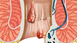 U hậu môn nguy hiểm không? Nguyên nhân và cách điều trị