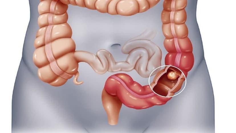 U lympho ruột non là gì? Chẩn đoán và điều trị như thế nào?