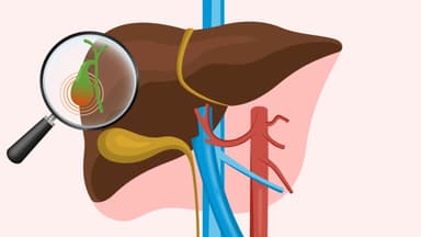 Ứ mật là gì? Nguyên nhân, triệu chứng và cách điều trị