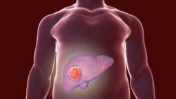 Phát hiện u máu gan phải làm sao? Cách chẩn đoán và điều trị