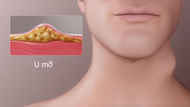 U mỡ có nguy hiểm không? Nhận biết dấu hiệu bất thường và cách xử lý
