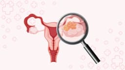 U nang buồng trứng: dấu hiệu nhận biết, chẩn đoán và hướng xử trí