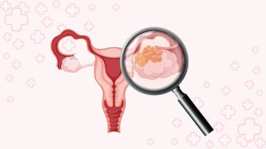 U nang buồng trứng: dấu hiệu nhận biết, chẩn đoán và hướng xử trí