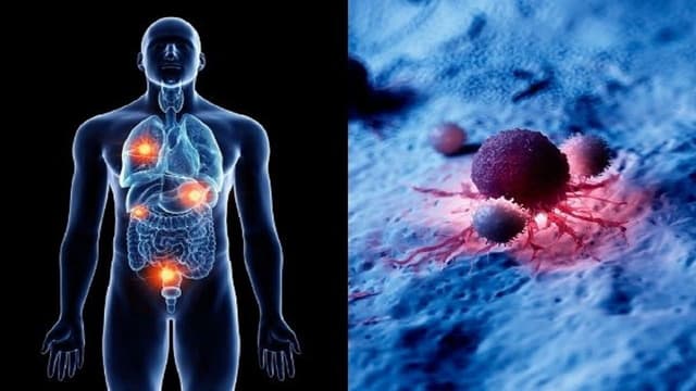 U thần kinh nội tiết trực tràng là gì và điều trị như thế nào?