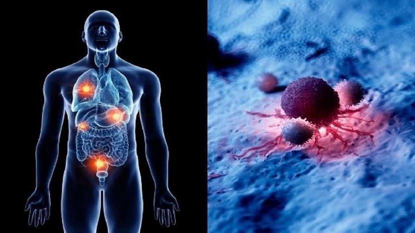 U thần kinh nội tiết trực tràng là gì và điều trị như thế nào?