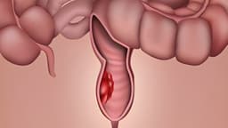 U trực tràng thấp là bệnh gì? Đánh giá mức độ nguy hiểm