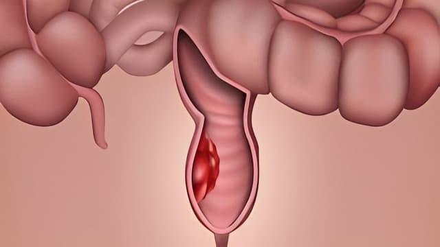 U trực tràng thấp là bệnh gì? Đánh giá mức độ nguy hiểm