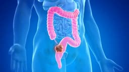 U trực tràng: Dấu hiệu nhận biết, nguyên nhân và cách điều trị