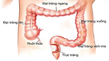 U tuyến đại tràng nguy hiểm không? Điều trị như thế nào?