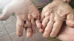 Vì sao cần theo dõi và điều trị sớm u xơ thần kinh?