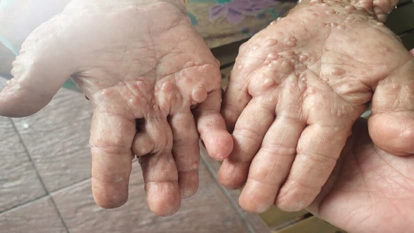Vì sao cần theo dõi và điều trị sớm u xơ thần kinh?