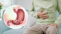 Ung thư dạ dày giai đoạn cuối: Tiên lượng và điều trị