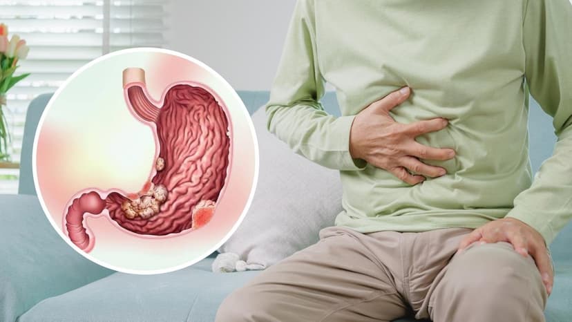 Ung thư dạ dày giai đoạn cuối: Tiên lượng và điều trị