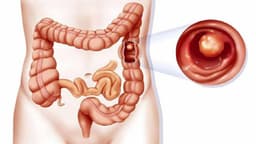 Ung thư đại tràng: Làm thế nào để chẩn đoán, điều trị hiệu quả?