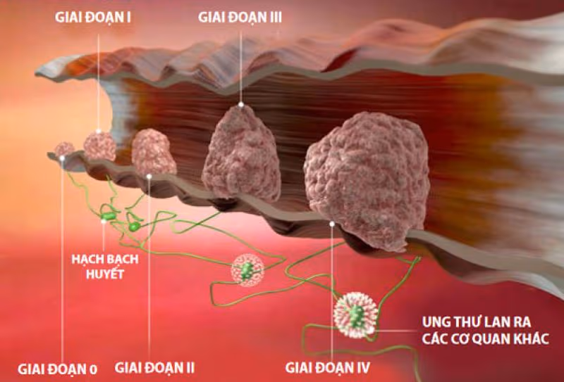 Các giai đoạn của ung thư trực tràng