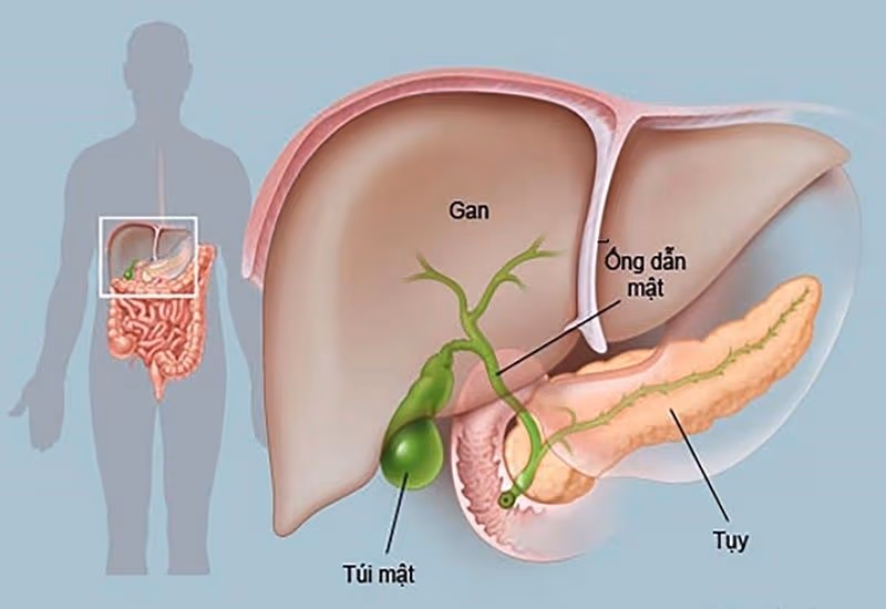 Ung thư túi mật là bệnh lý ác tính hình thành từ các tế bào của túi mật