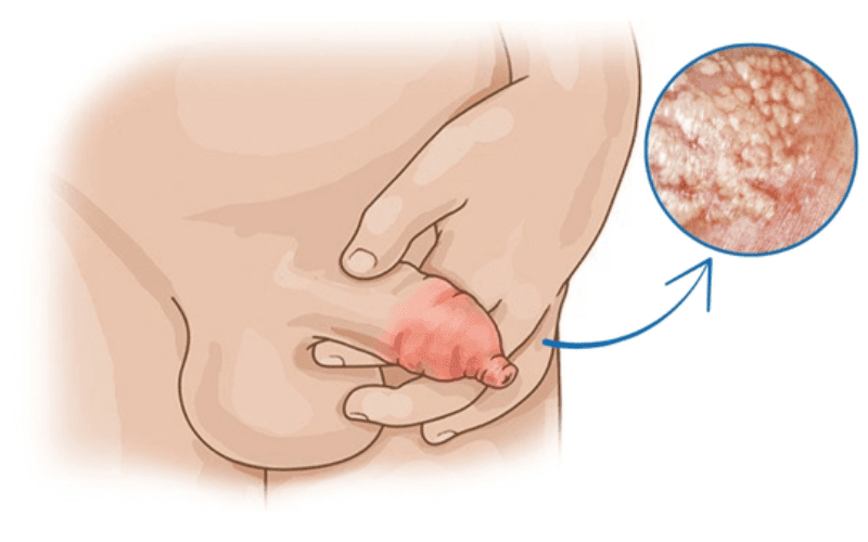 Viêm bao quy đầu là bệnh gì?