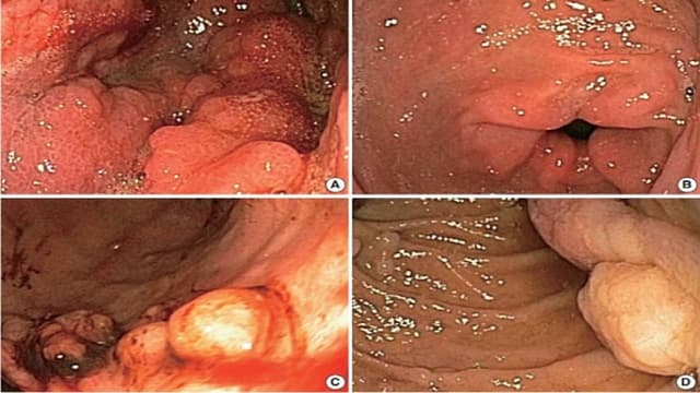 Viêm dạ dày phì đại có nguy hiểm không? Điều trị thế nào?