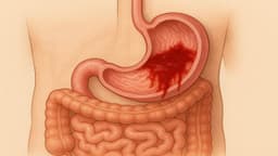 Viêm dạ dày xuất huyết được chẩn đoán và điều trị như thế nào?