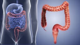 Viêm đại tràng giả mạc là gì? Triệu chứng, nguyên nhân và cách điều trị