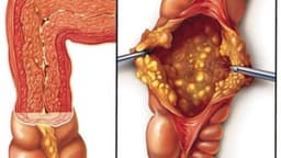 Viêm đại tràng nhiễm trùng là gì? Nguyên nhân, triệu chứng và cách điều trị