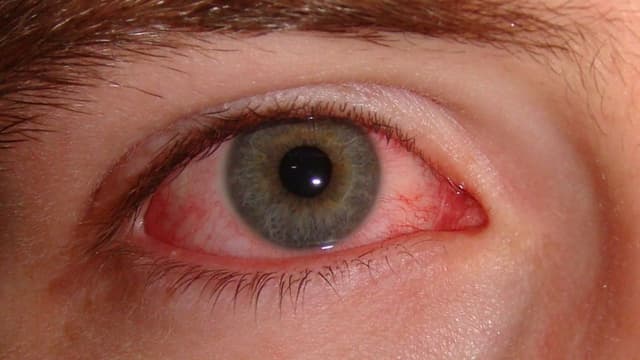 Viêm kết mạc là gì? Dấu hiệu, chẩn đoán và điều trị