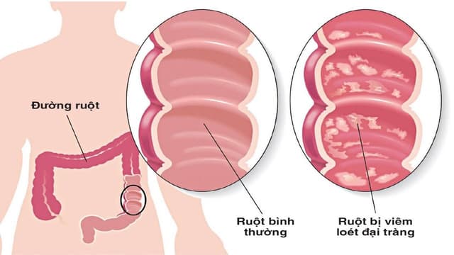 Viêm loét đại tràng do đâu? Hướng kiểm soát bệnh lâu dài thế nào?