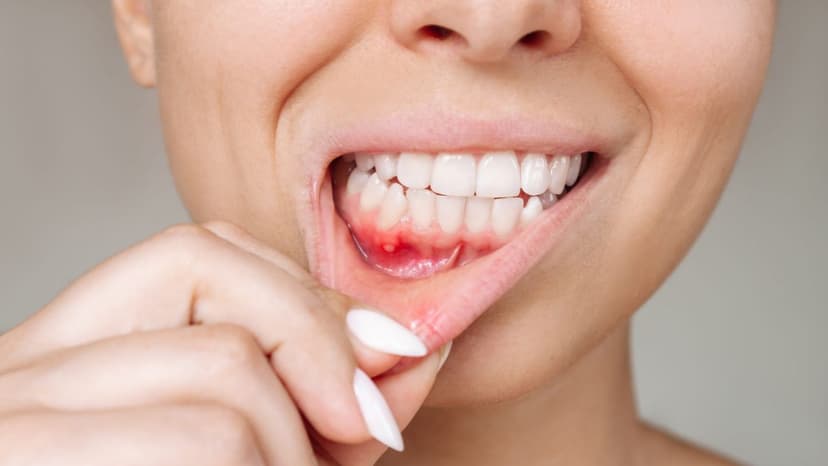 Viêm lợi: Dấu hiệu nhận biết, chẩn đoán và điều trị như thế nào?