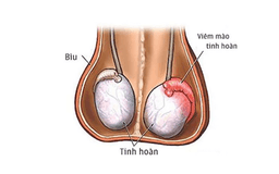 Viêm mào tinh hoàn là bệnh gì?