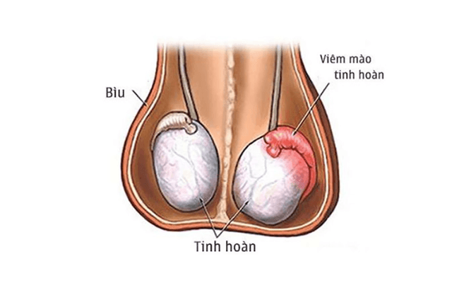 Viêm mào tinh hoàn là bệnh gì?